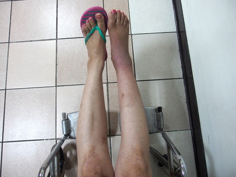 フィリピン留学で骨折してギブス生活、右足は細くなっている。歩けるか不安